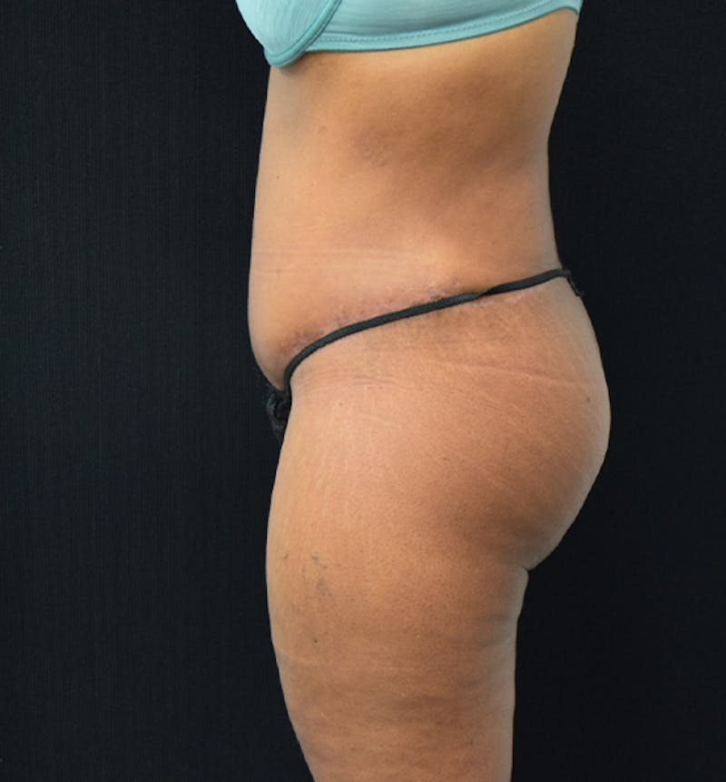 Lower Body Lift Before & After Gallery - Patient 102567166 - Image 8