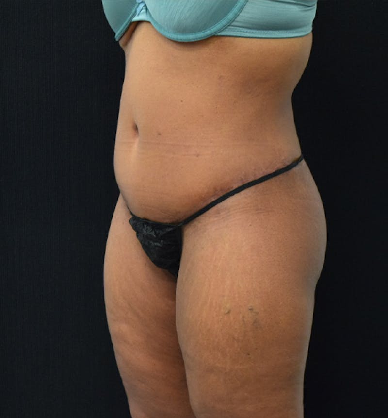Lower Body Lift Before & After Gallery - Patient 102567166 - Image 10