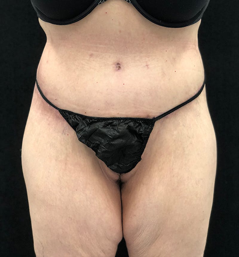 Lower Body Lift Before & After Gallery - Patient 102567174 - Image 2
