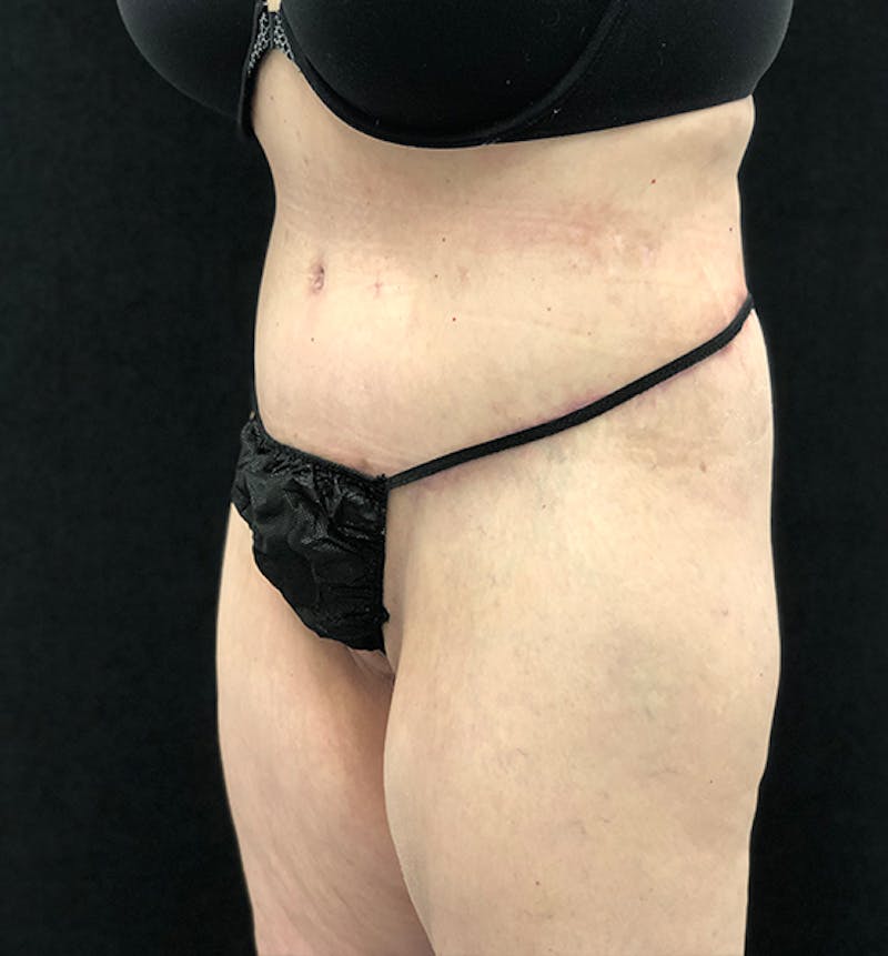 Lower Body Lift Before & After Gallery - Patient 102567174 - Image 4