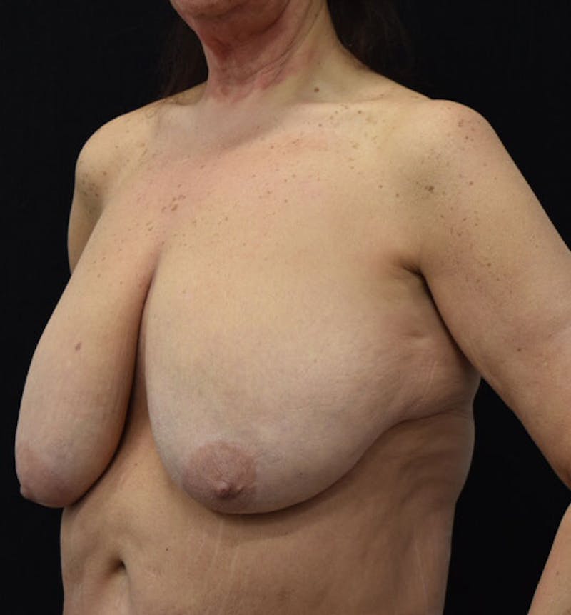 Breast Lift Before & After Gallery - Patient 102567169 - Image 1