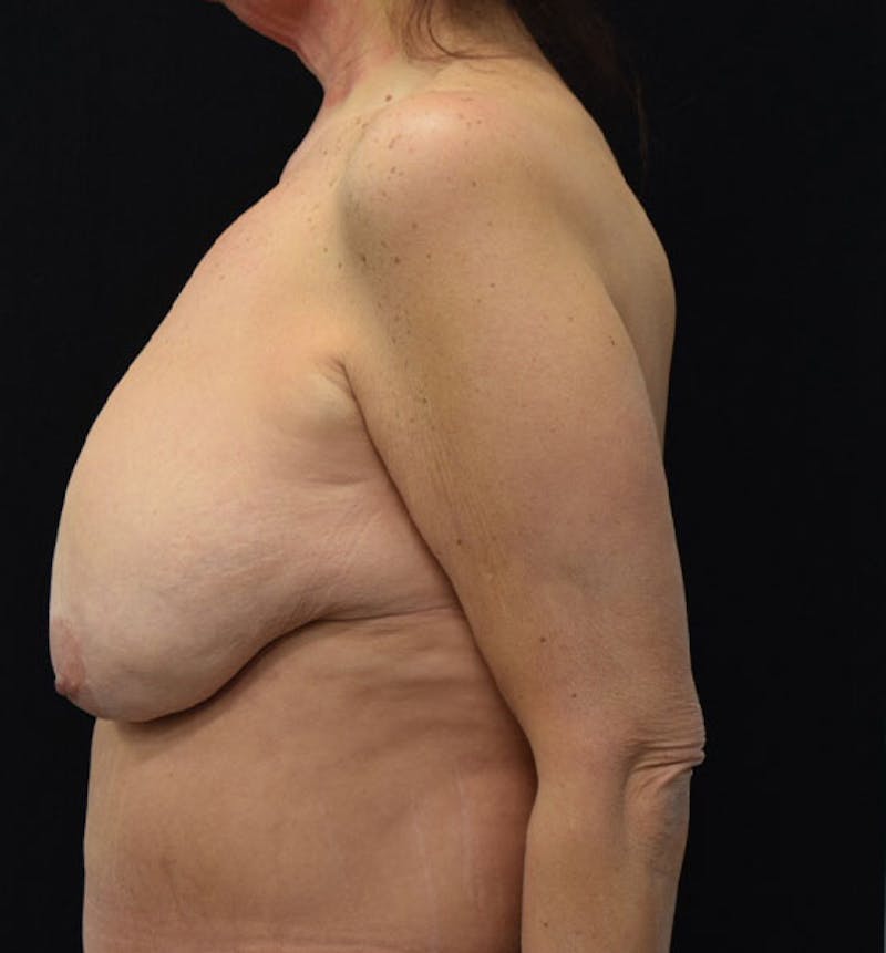 Breast Lift Before & After Gallery - Patient 102567169 - Image 3