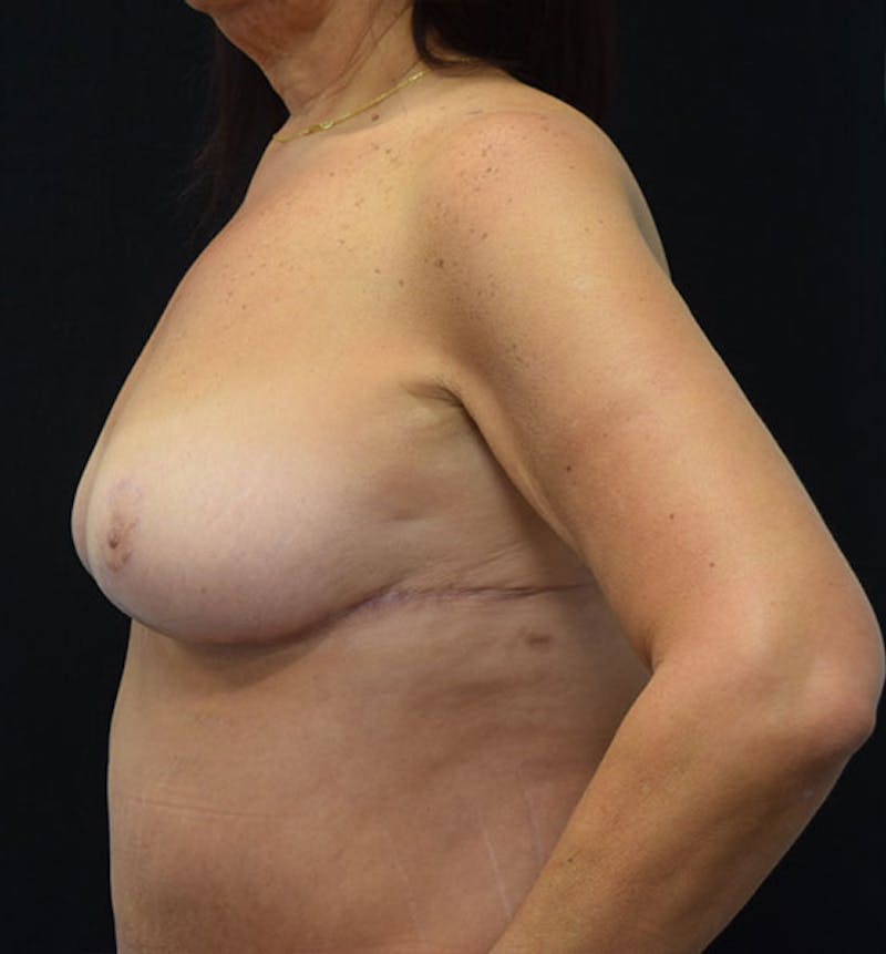 Breast Lift Before & After Gallery - Patient 102567169 - Image 4