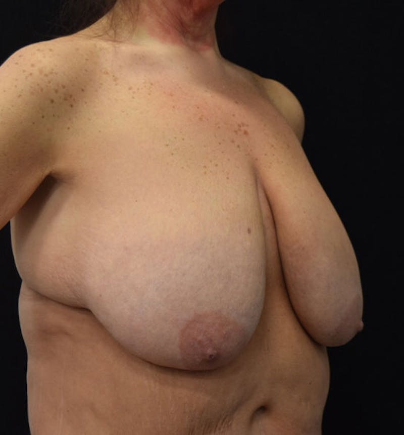 Breast Lift Before & After Gallery - Patient 102567169 - Image 5