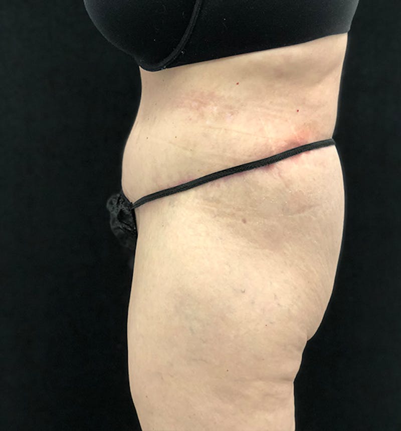 Lower Body Lift Before & After Gallery - Patient 102567174 - Image 6