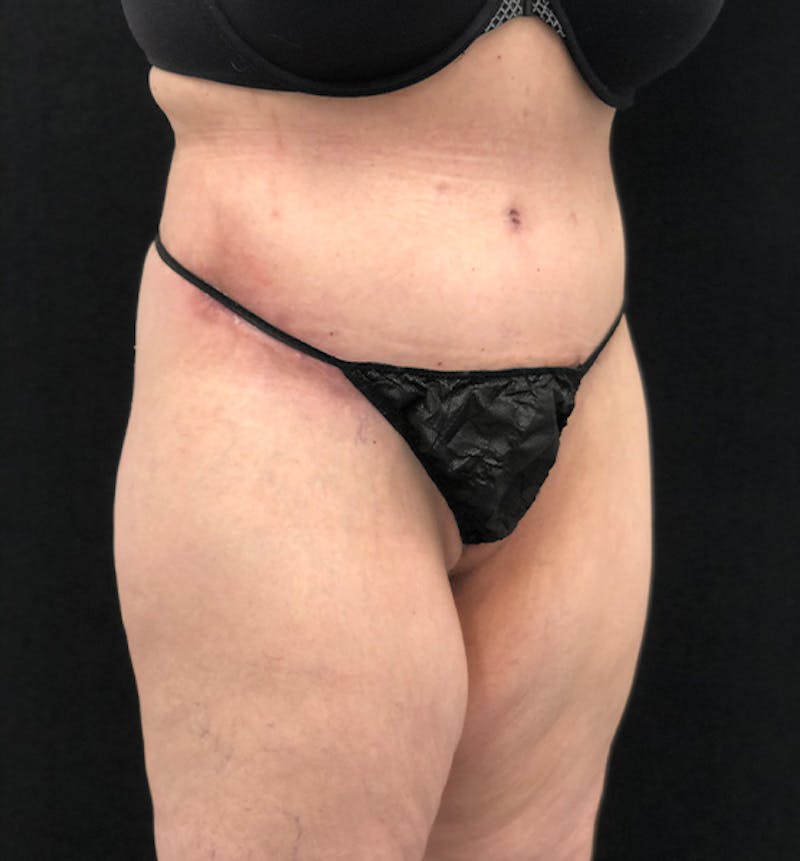 Lower Body Lift Before & After Gallery - Patient 102567174 - Image 8