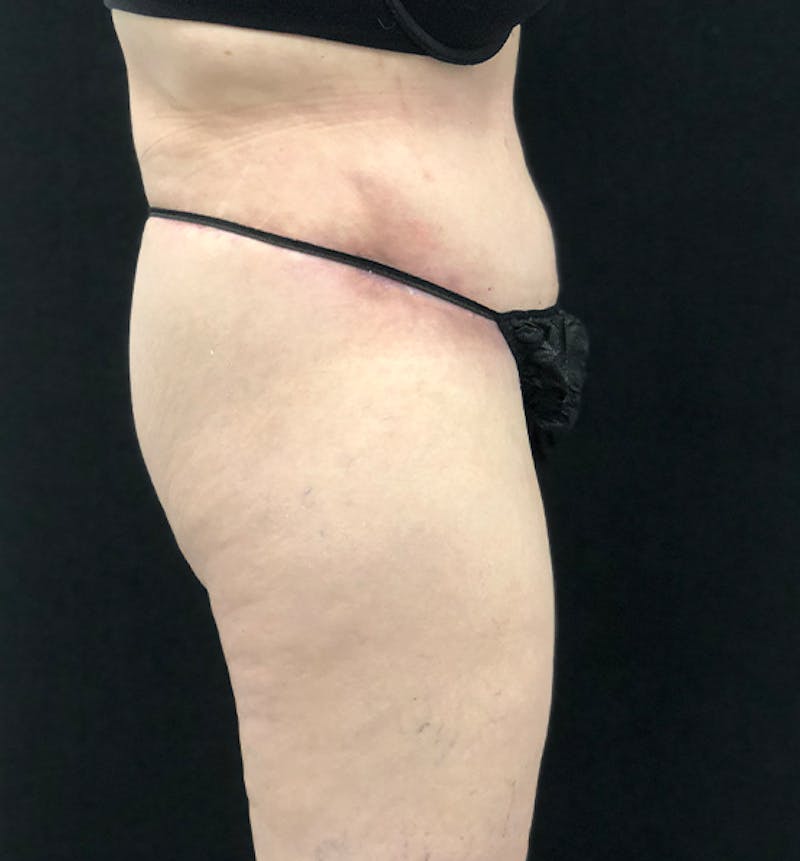 Lower Body Lift Before & After Gallery - Patient 102567174 - Image 10