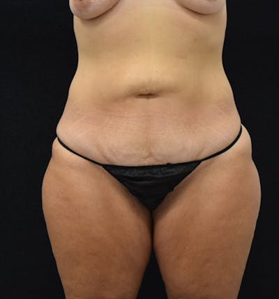 Lower Body Lift Before & After Gallery - Patient 102567176 - Image 1