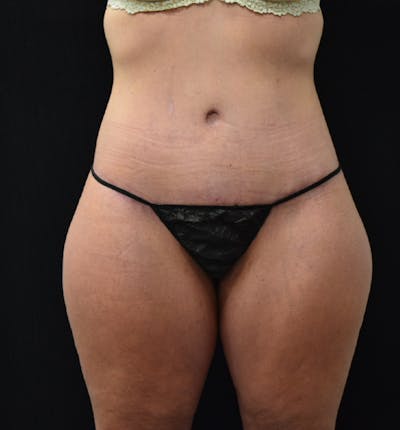Lower Body Lift Before & After Gallery - Patient 102567176 - Image 2