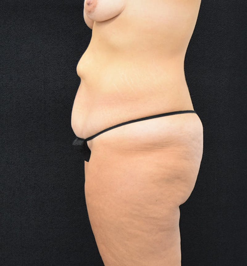 Lower Body Lift Before & After Gallery - Patient 102567176 - Image 5