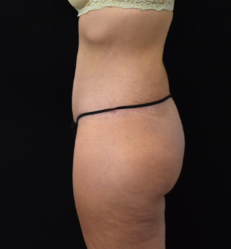 Lower Body Lift Before & After Gallery - Patient 102567176 - Image 6