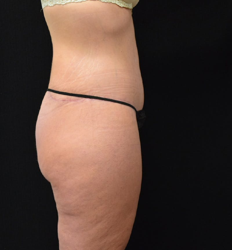 Lower Body Lift Before & After Gallery - Patient 102567176 - Image 8