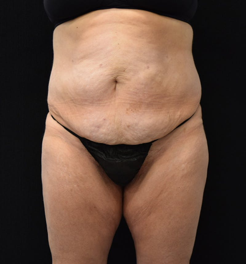 Lower Body Lift Before & After Gallery - Patient 102567181 - Image 1