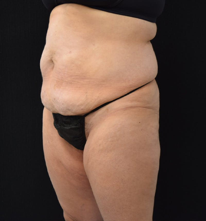Lower Body Lift Before & After Gallery - Patient 102567181 - Image 3