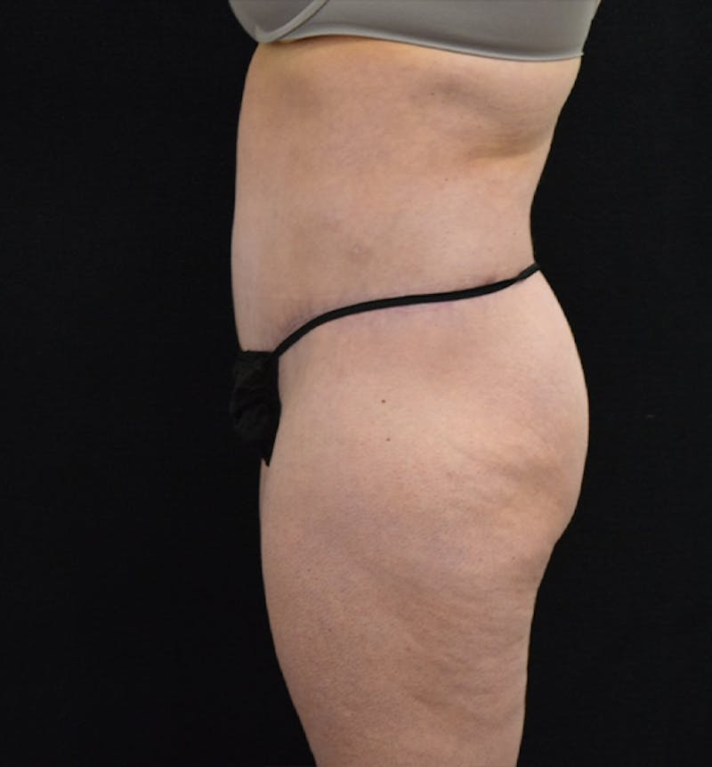 Lower Body Lift Before & After Gallery - Patient 102567181 - Image 6