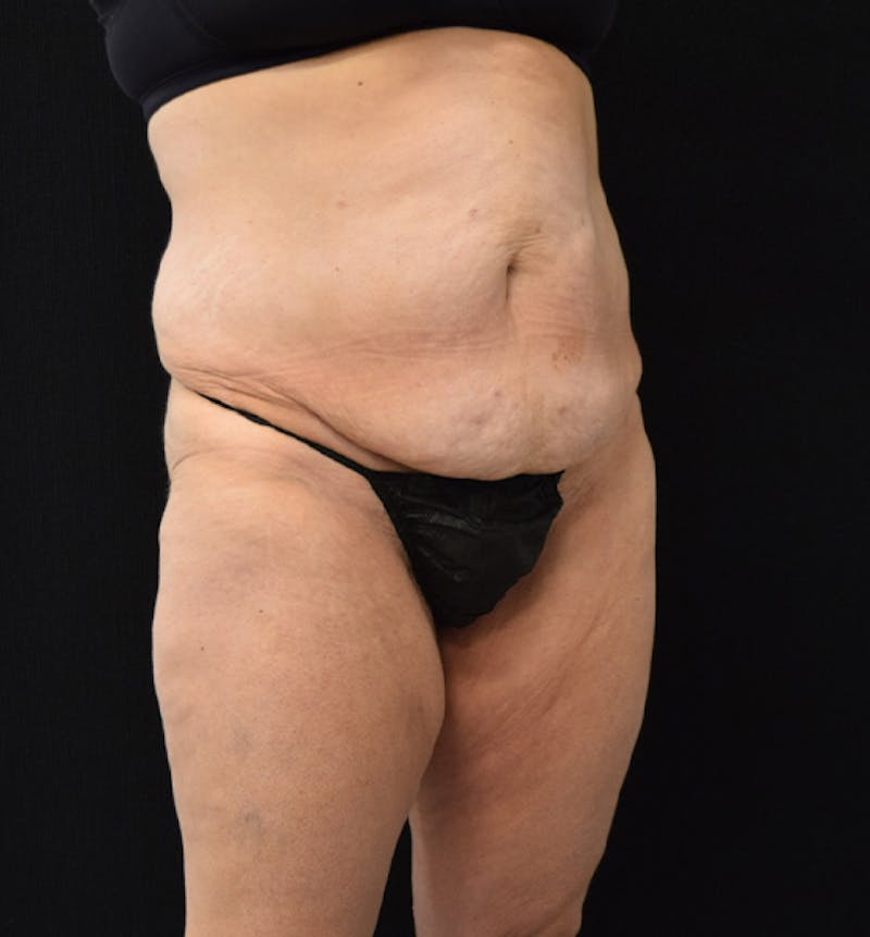 Lower Body Lift Before & After Gallery - Patient 102567181 - Image 7