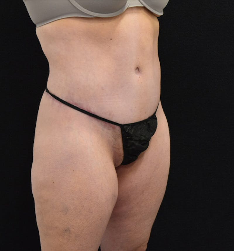 Lower Body Lift Before & After Gallery - Patient 102567181 - Image 8