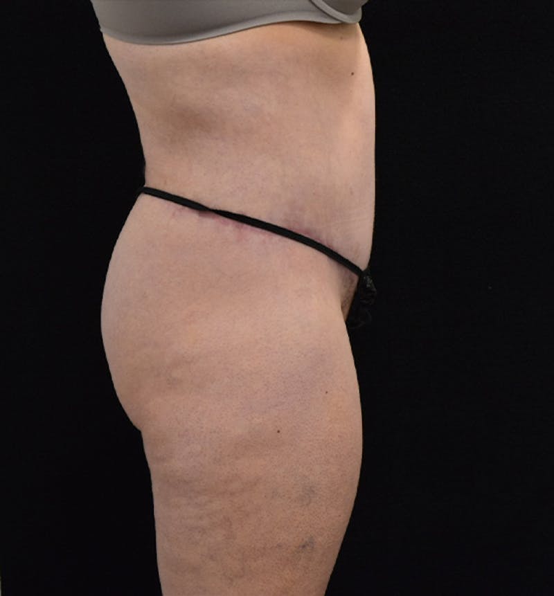 Lower Body Lift Before & After Gallery - Patient 102567181 - Image 10