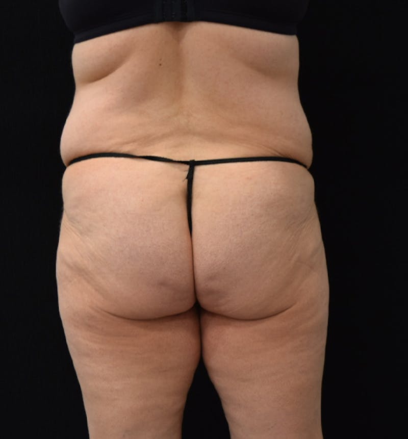 Lower Body Lift Before & After Gallery - Patient 102567181 - Image 11