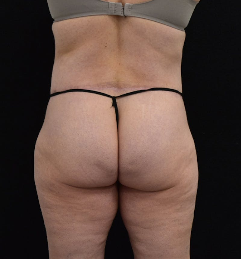 Lower Body Lift Before & After Gallery - Patient 102567181 - Image 12