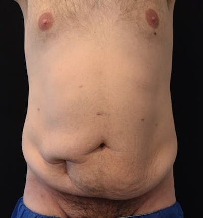 Male Lower Body Lift Before & After Gallery - Patient 148037532 - Image 1