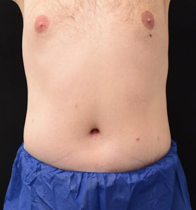 Male Lower Body Lift Before & After Gallery - Patient 148037532 - Image 2
