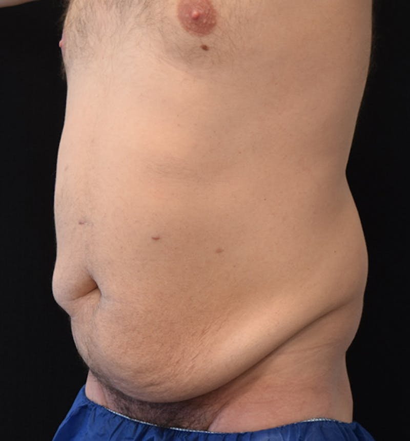 Male Lower Body Lift Before & After Gallery - Patient 148037532 - Image 3
