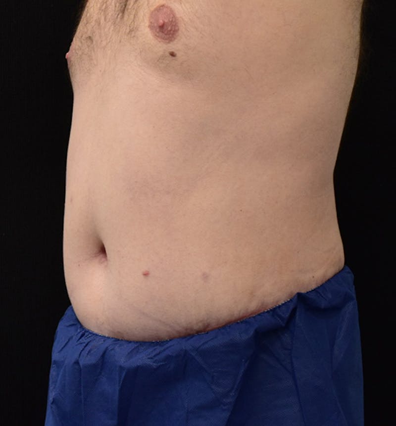Male Lower Body Lift Before & After Gallery - Patient 148037532 - Image 4