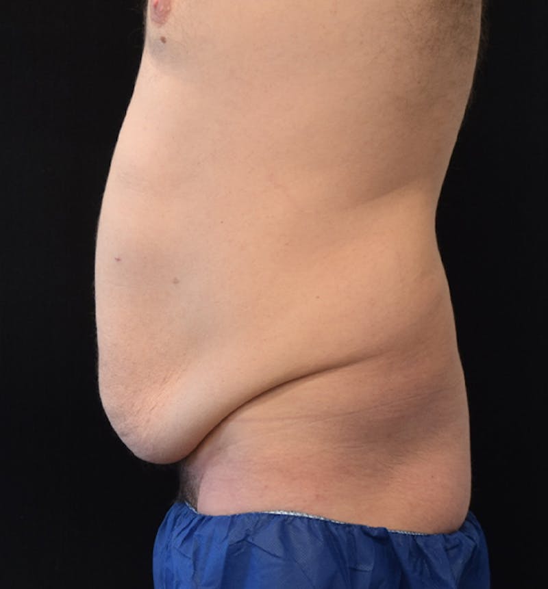 Male Lower Body Lift Before & After Gallery - Patient 148037532 - Image 5