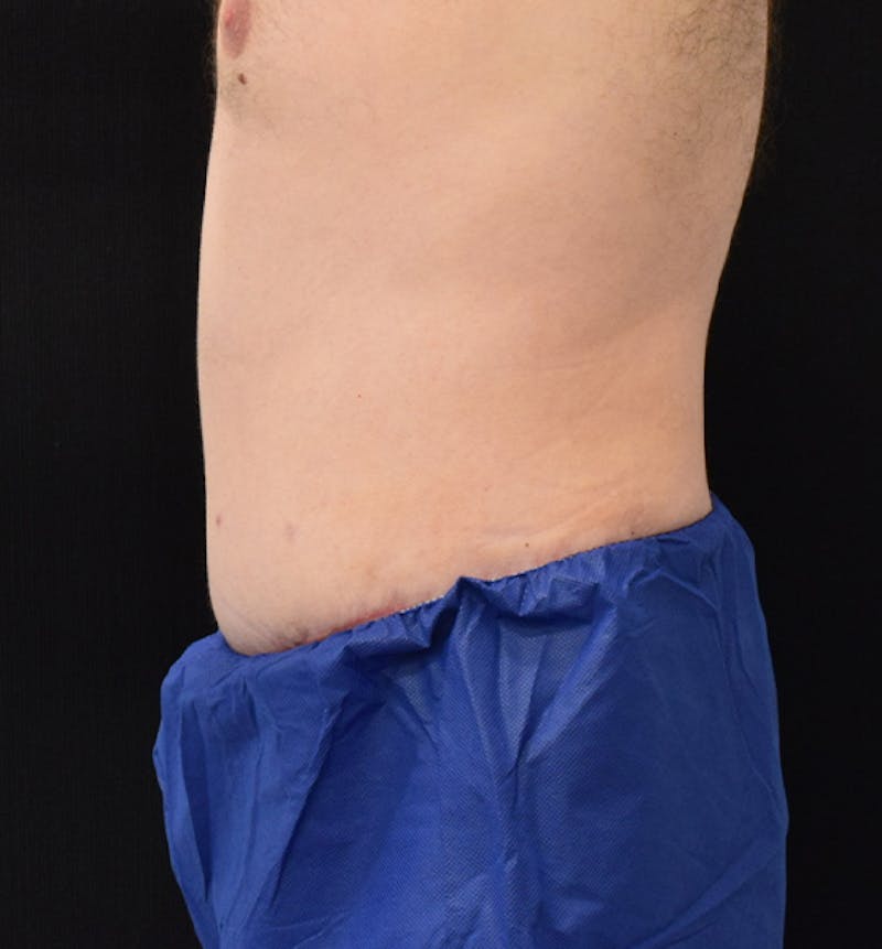 Male Lower Body Lift Before & After Gallery - Patient 148037532 - Image 6