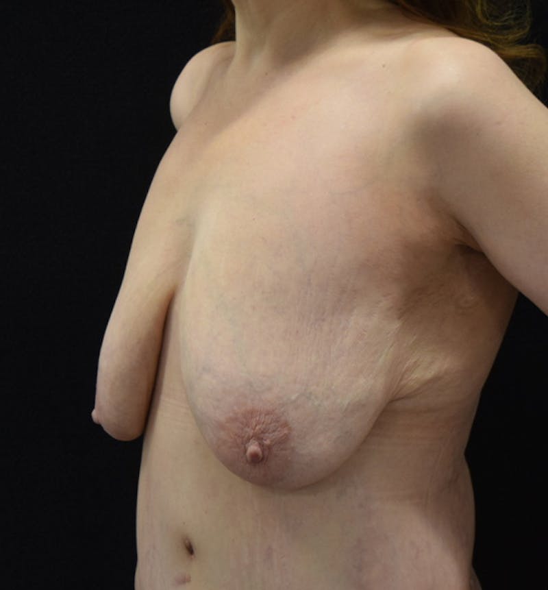 Breast Lift Before & After Gallery - Patient 102567191 - Image 3