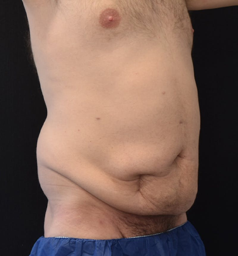 Male Lower Body Lift Before & After Gallery - Patient 148037532 - Image 7