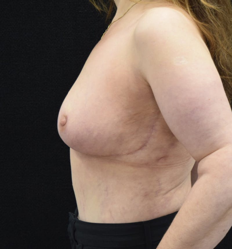 Breast Lift Before & After Gallery - Patient 102567191 - Image 6