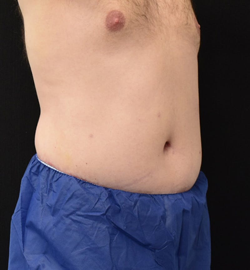 Male Lower Body Lift Before & After Gallery - Patient 148037532 - Image 8