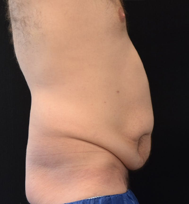 Male Lower Body Lift Before & After Gallery - Patient 148037532 - Image 9