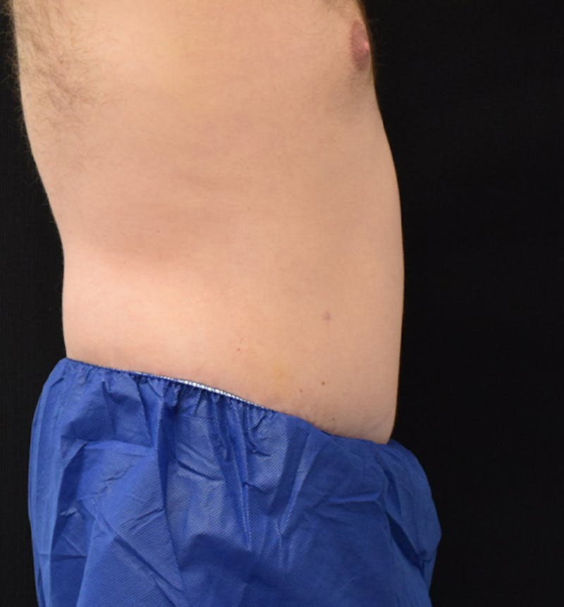 Male Lower Body Lift Before & After Gallery - Patient 148037532 - Image 10