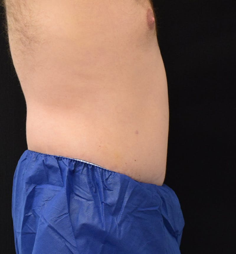 Lower Body Lift Before & After Gallery - Patient 102567193 - Image 10