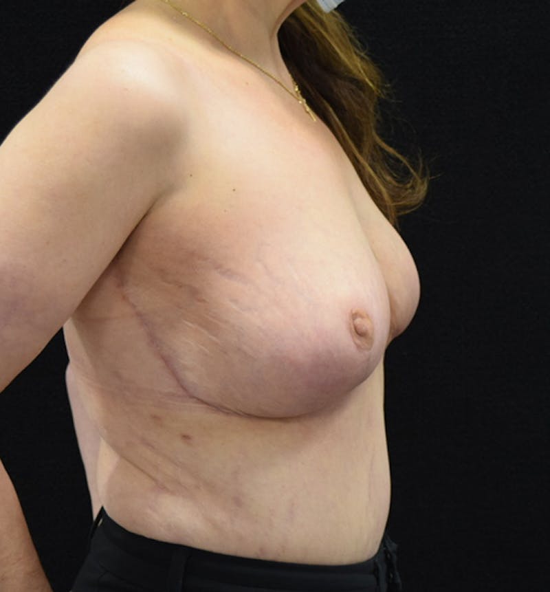 Breast Lift Gallery - Patient 102567191 - Image 10
