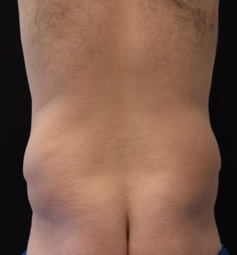 Male Lower Body Lift Before & After Gallery - Patient 148037532 - Image 11