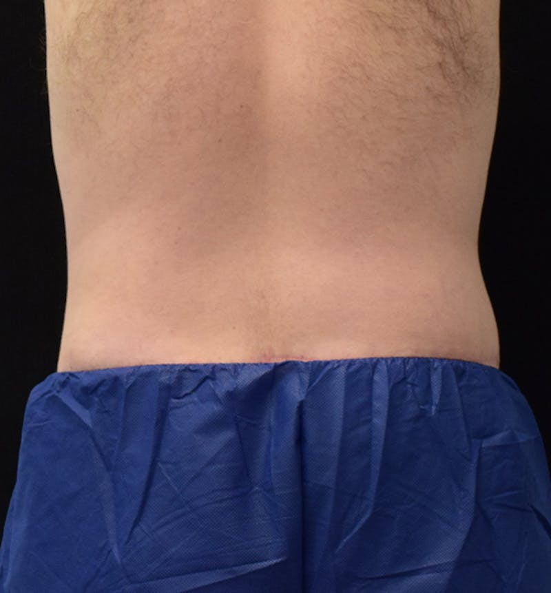 Male Lower Body Lift Before & After Gallery - Patient 148037532 - Image 12