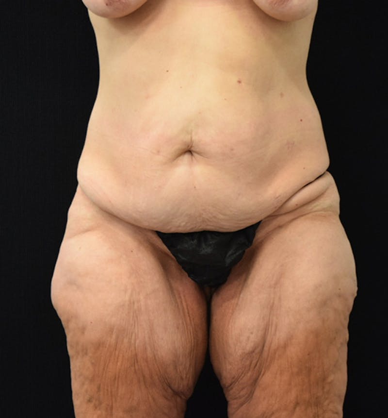 Lower Body Lift Before & After Gallery - Patient 102567206 - Image 1