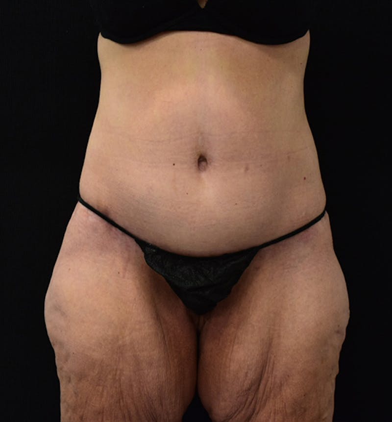 Lower Body Lift Before & After Gallery - Patient 102567206 - Image 2