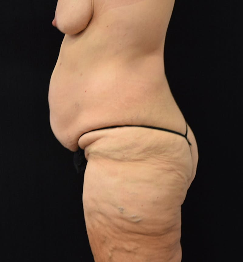 Lower Body Lift Before & After Gallery - Patient 102567206 - Image 3