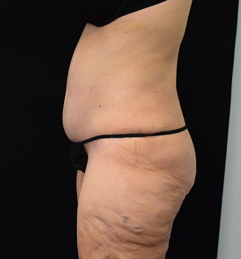 Lower Body Lift Before & After Gallery - Patient 102567206 - Image 4