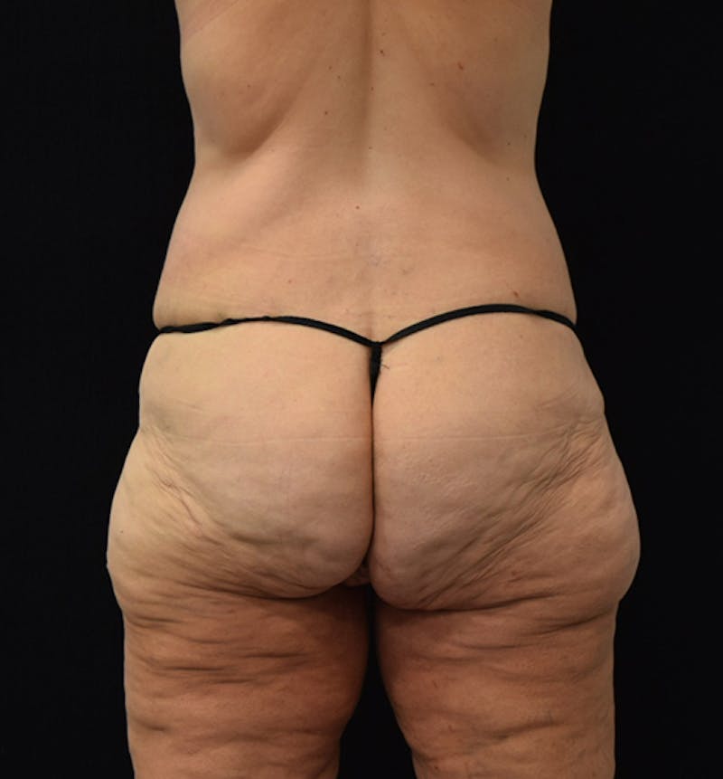 Lower Body Lift Before & After Gallery - Patient 102567206 - Image 5
