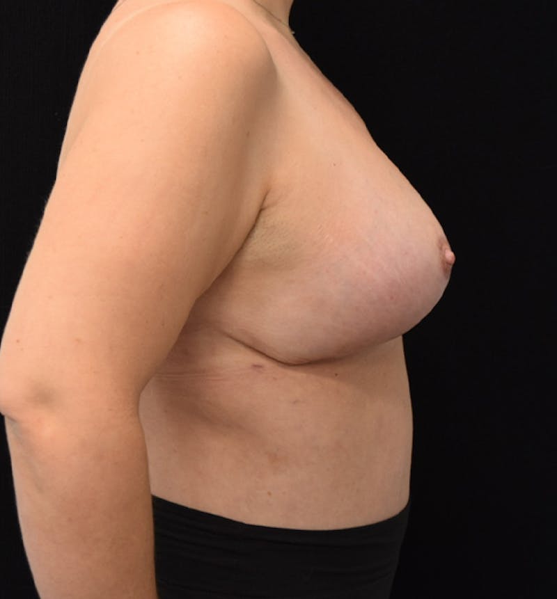 Breast Lift Before & After Gallery - Patient 102567205 - Image 6