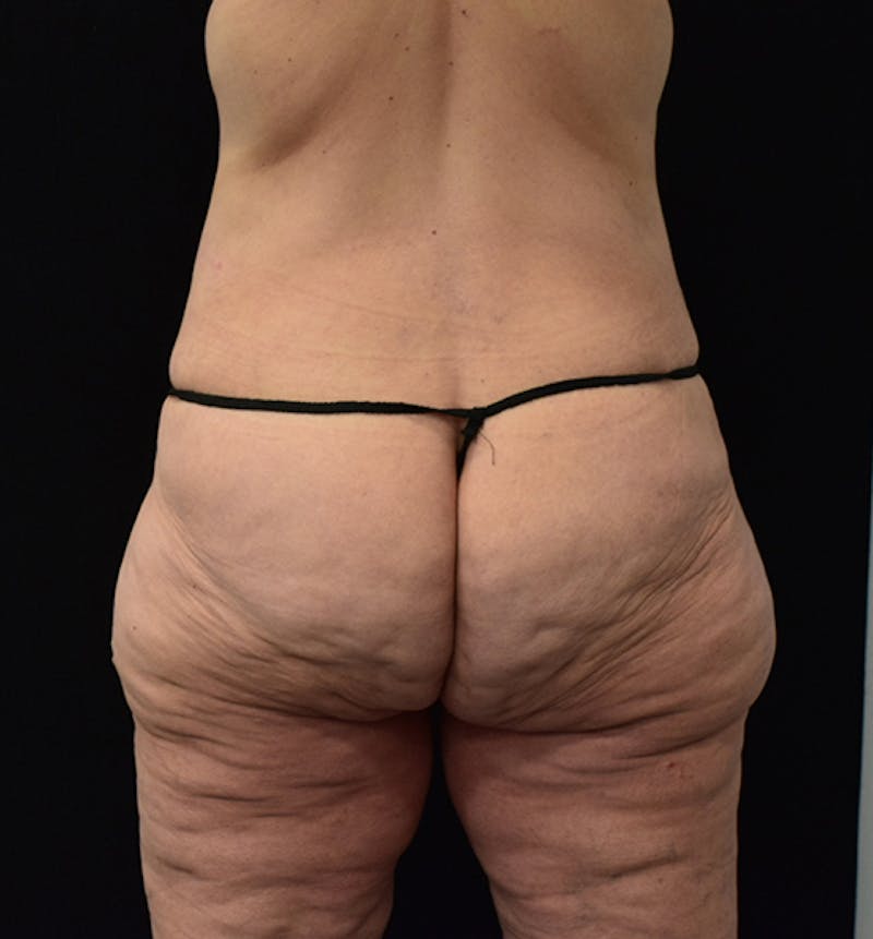 Lower Body Lift Gallery - Patient 102567206 - Image 6