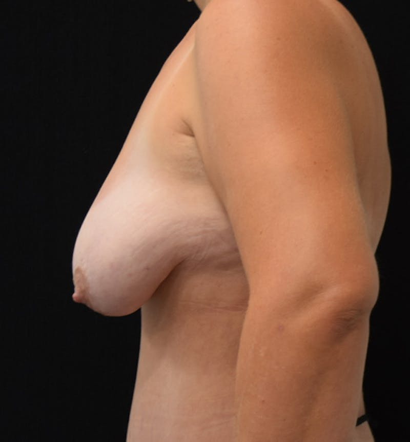 Breast Lift Gallery - Patient 102567205 - Image 7