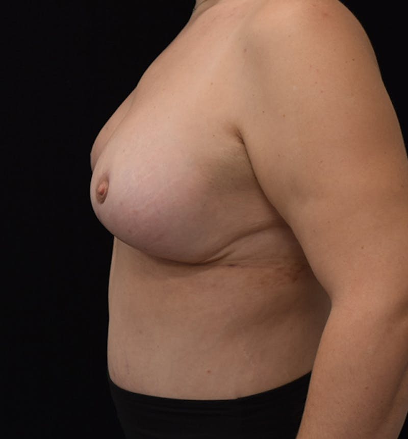 Breast Lift Before & After Gallery - Patient 102567205 - Image 8