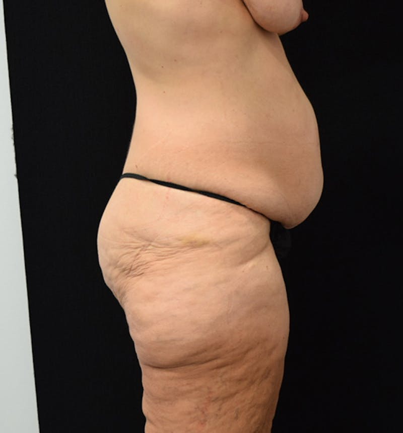 Lower Body Lift Before & After Gallery - Patient 102567206 - Image 7